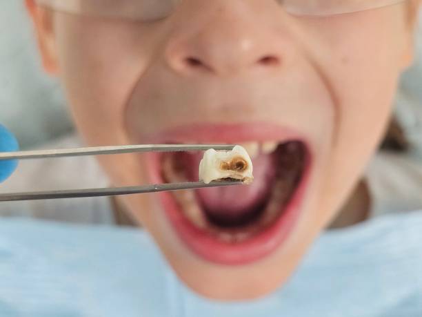 Best Emergency Treatment for Oral Infections in Haiku Pauwela, HI